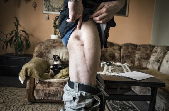 Andrzej Biel w swoim domu demonstruje bliznę po operacji nogi, Radom, 21 marca 2014 roku (źródło: materiały prasowe organizatora)